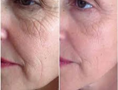 Profhilo same day in Wetherby and York for smooth skin and injectable moisturiser, glowing skin 