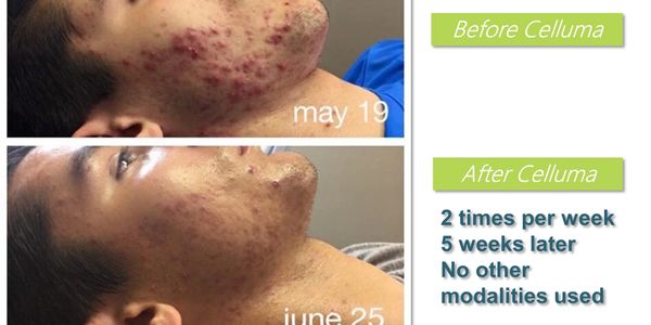 Celluma Pro acne treatment before and after