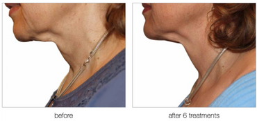 Before and after six radiofrequency treatment sessions