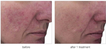 Before and after one radiofrequency treatment session