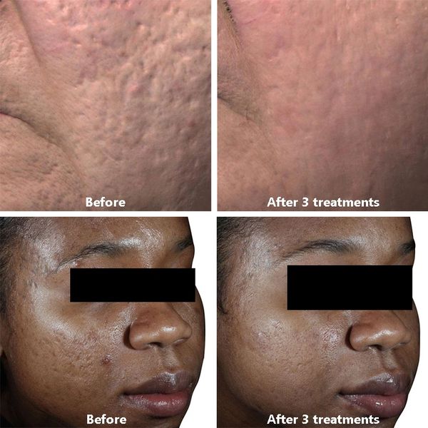Before and after Venus Viva skin resurfacing treatments.