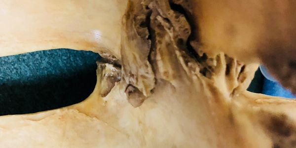 Diseased spinal facet joints.  Even pets get spinal arthritis.