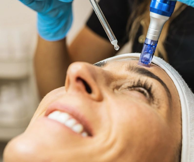 Microneedling treatment being performed by a professional