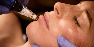 Close-up of a woman receiving a facial injection treatment.