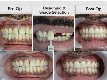 Dental restoration process showing pre-op, shade selection, and post-op images.