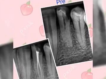 Dental X-rays showing pre and post root canal treatment.