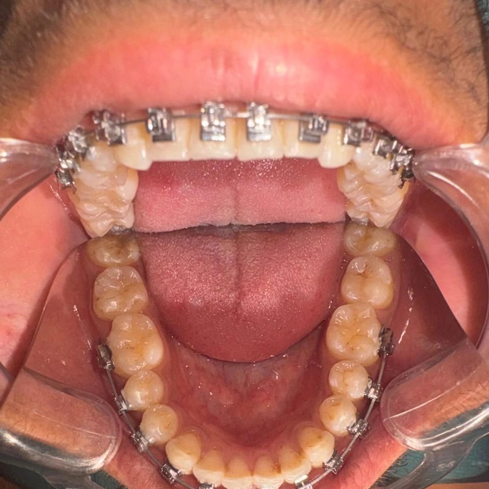Close-up of teeth with braces on upper and lower arches.
