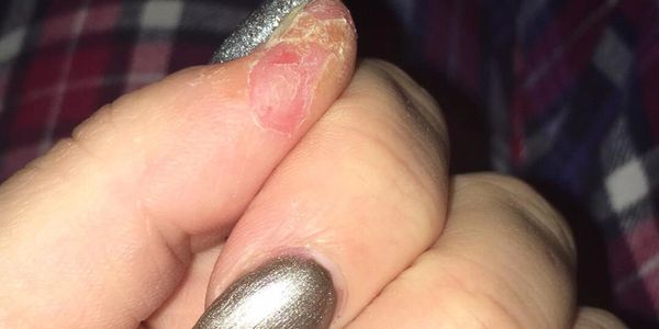 Contact dermatitis caused by nail product skin contact