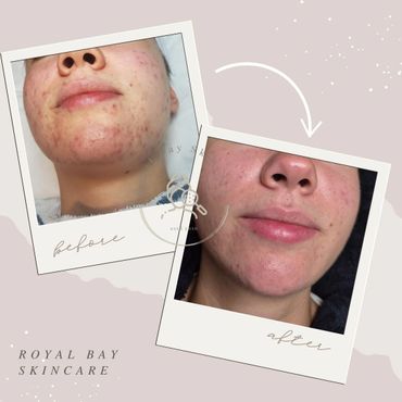 face acne acne before and after