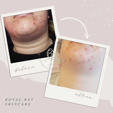 chin acne acne before and after