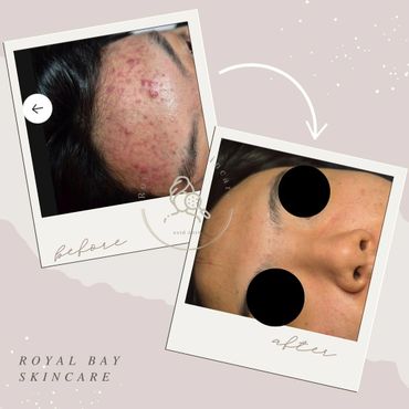 acne before and after forehead acne