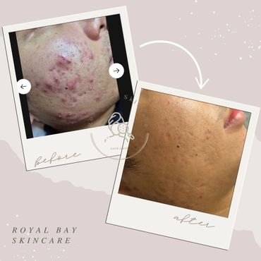 acne before and after