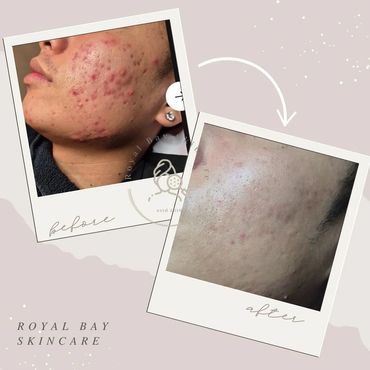 acne before and after