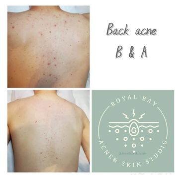 back acne