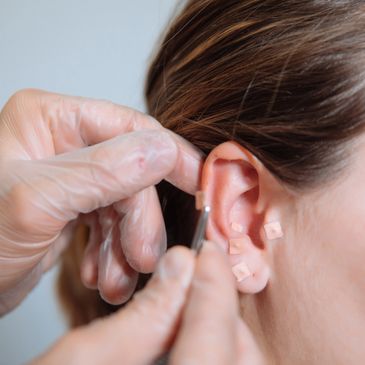Auricular Acupuncture for Allergies