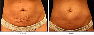 Body wrap results