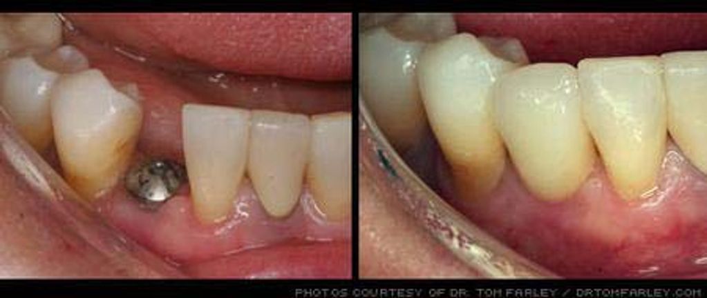Before and After a Dental Implant