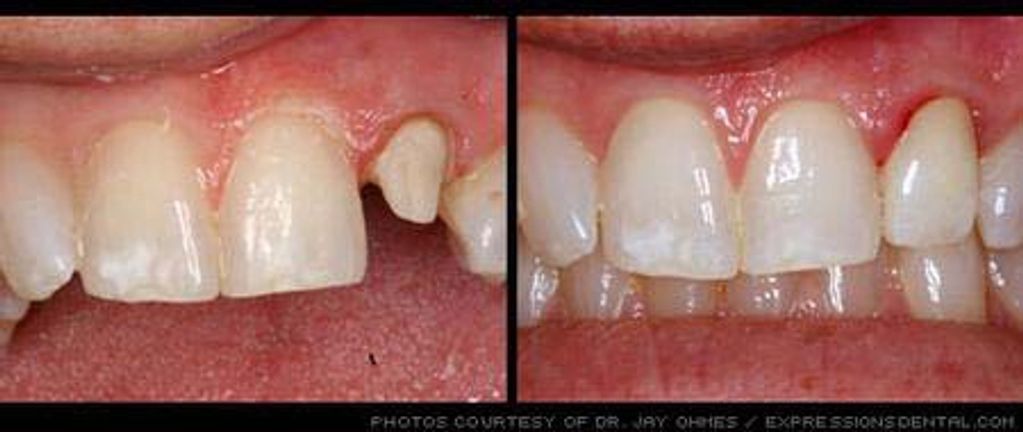Before and After a Tooth Crown