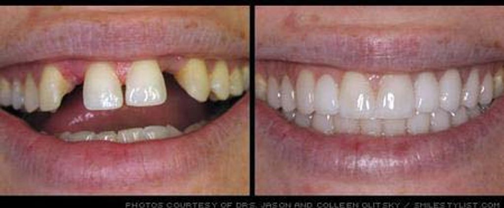 Before and After a Dental Bridge