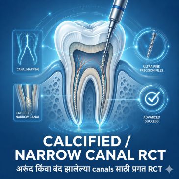 Tooth illustration showing calcified narrow canal root canal treatment with canal mapping and ultra-