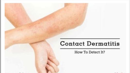 Contact dermatitis a skin condition after contact with allergen,  red, itchy rash, not contagious