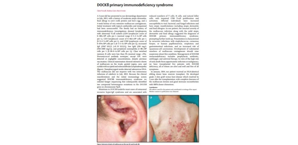 DOCK8 deficiency is immune deficiency with viral infections of the skin along with allergies