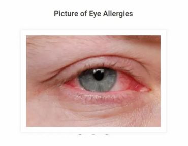 Eye allergy