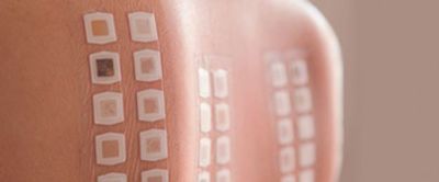 Allergy skin testing using patch to determine the cause of skin allergy, contact dermatitis, rash.