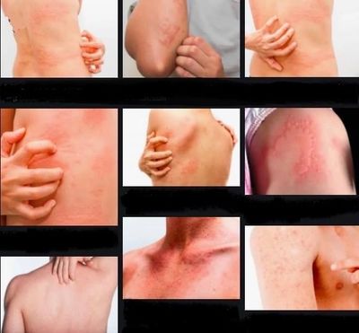 Allergic Contact Rash
Eczema (Atopic Dermatitis)
Hives (Urticaria)
Poison Ivy, Sumac, Oak
Pruritus
