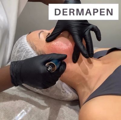 Dermapen treatment, Collagen Induction Therapy, Vampire Facial, Microneedling, Acne Scarring.