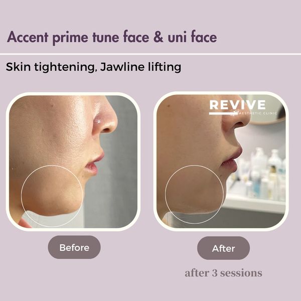 Accent prime before after