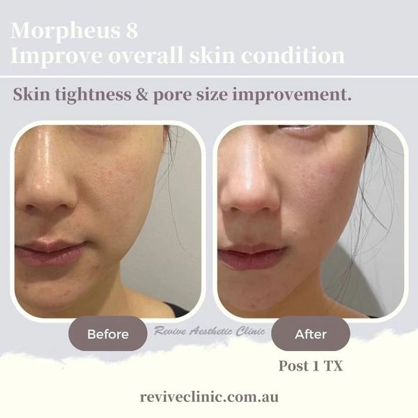 Inmode Morpheus8 before after revive aesthetic clinic