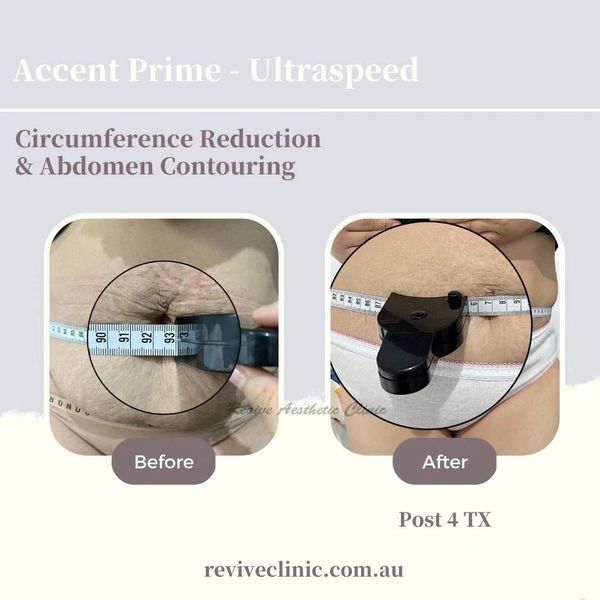 Accent prime tune body body shaping treatment