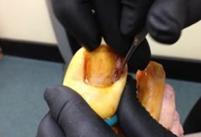 Toe Nail Surgery is often performed at Forest Lake Podiatry Clinic.