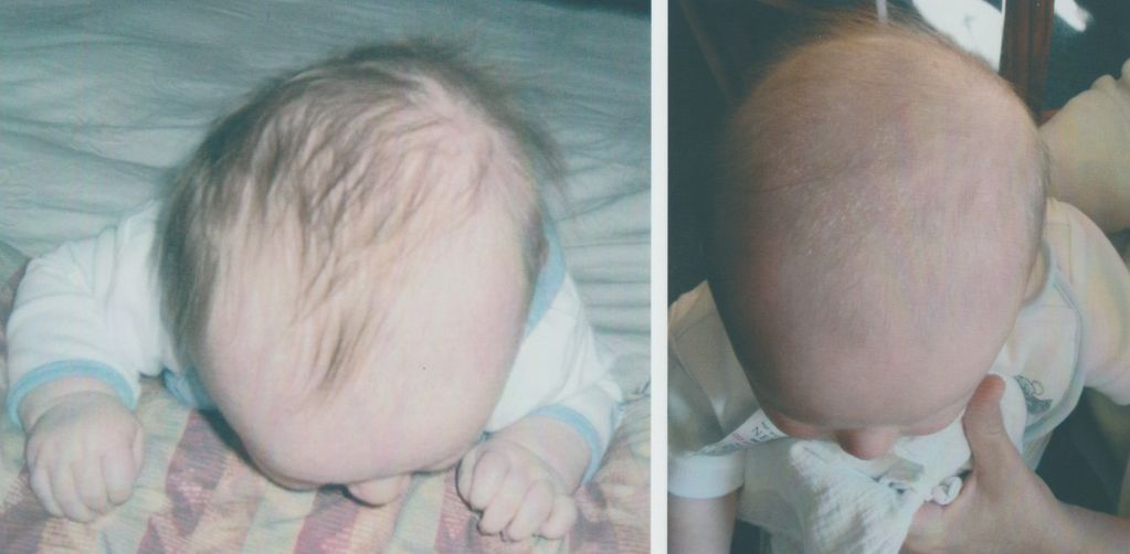 PICTURE OF BABYS SKULL