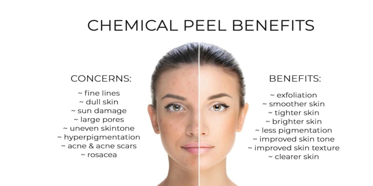 Chemical Peel Info