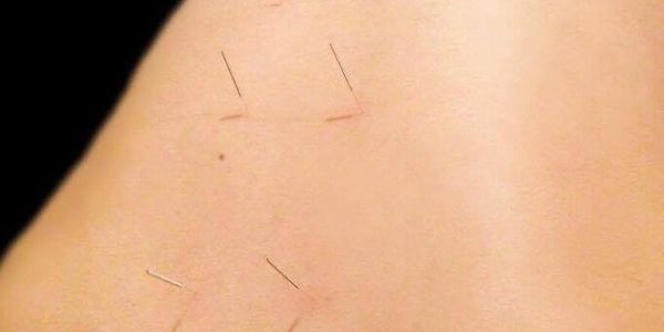 Fine, sterile needles .are inserted into specific acupuncture points, varying with each individual