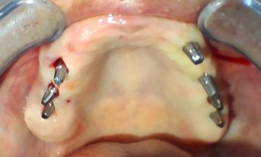 Implnatologie orale
Implant dentaire
Dental implant
Cabinet dr ben amor nour el houda