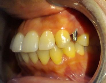 Implnatologie orale
Implant dentaire
Dental implant
Cabinet dr ben amor nour el houda