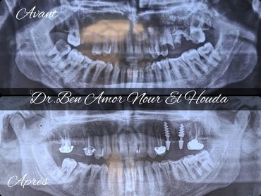 Implnatologie orale
Implant dentaire
Dental implant
Cabinet dr ben amor nour el houda