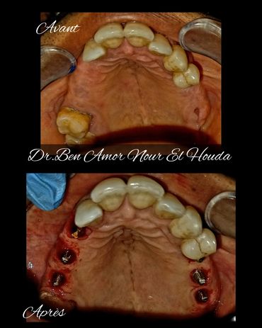 implant dentaire
dental implant
cabinet dr ben amor nour el houda