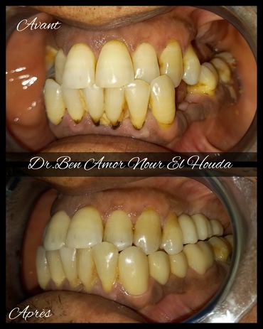 cabinet dr ben amor nour el houda
pose d'implant esthetique avec docteur nour el houda ben amor