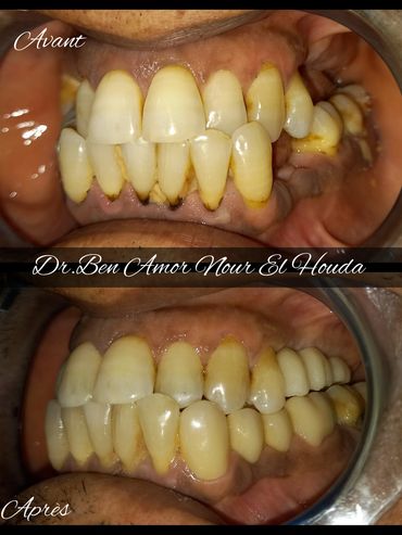 implant dentaire
dental implant
cabinet dr ben amor nour el houda
