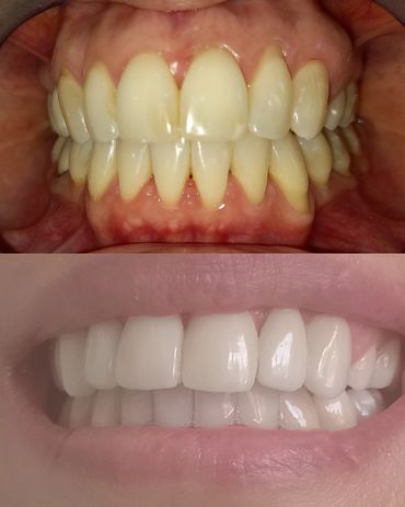 facettes dentaire
cabinet dr ben amor nour el houda