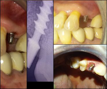 cabinet dr ben amor nour el houda
implants dentaire
pose d'implant esthetique
prothese sur implant