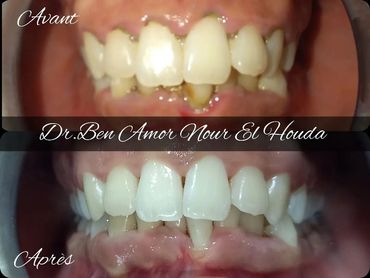 blanchiment dentaire
cabinet dentaire dr ben amor nour el houda
teeth whitening