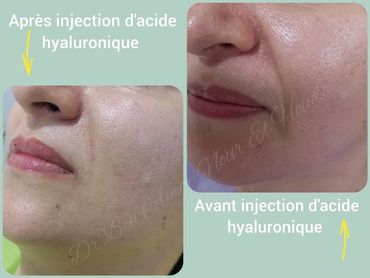 injection acide hyaluronique
filler
rides et sillon
levres pulpeuse
