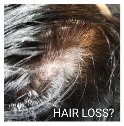 FabULash Artistry scalp micropigmentation before photo, hair loss treatment Jacksonville, FL.