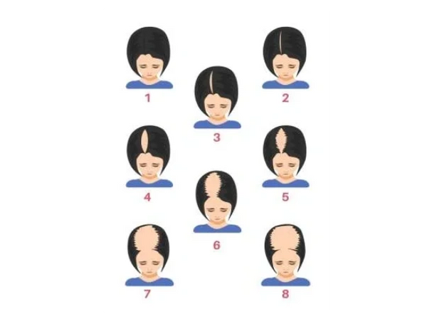 Stages of female pattern thinning from mild to advanced.