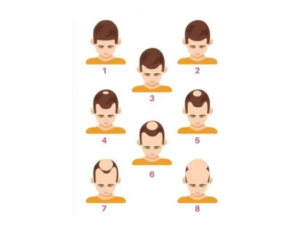 Stages of male pattern hair loss from minimal thinning to advanced baldness.